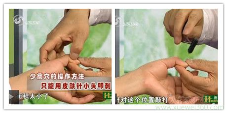 少商穴的操作方法只能用皮肤针小头叩刺，因为它面积太小了，敲打出血来