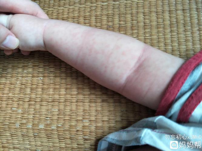 幼儿急疹症状,幼儿急疹症状和表现