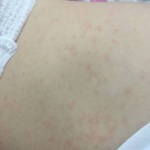幼儿急疹症状,幼儿急疹症状和表现
