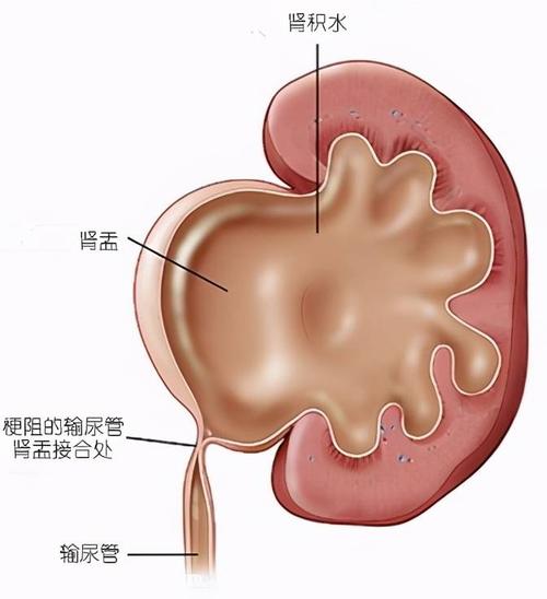 肾积水症状,孕妇肾积水症状